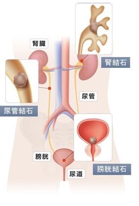 当院の尿路結石症治療について