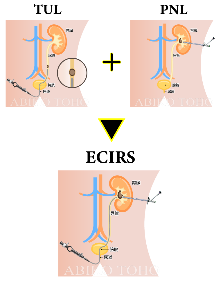 ECIRS