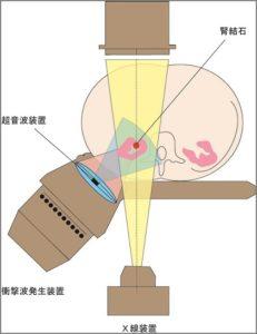 結石破砕装置イメージ