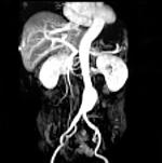 腹部大動脈瘤MRI