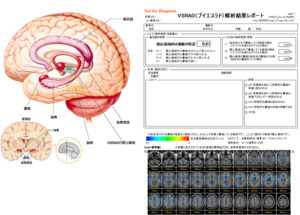 VSRAD（早期アルツハイマー型認知症診断支援システム）