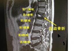 骨密度腰椎