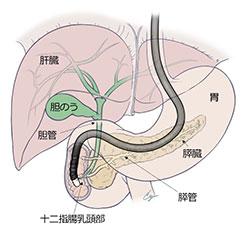 内視鏡的逆行性胆管膵管造影(左画像)