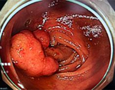 大腸カメラ(左画像)